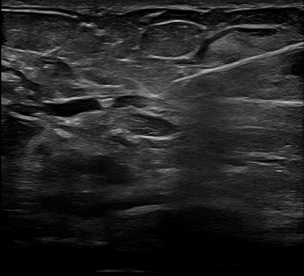 Does ultrasound visibility influence localisation preference?
