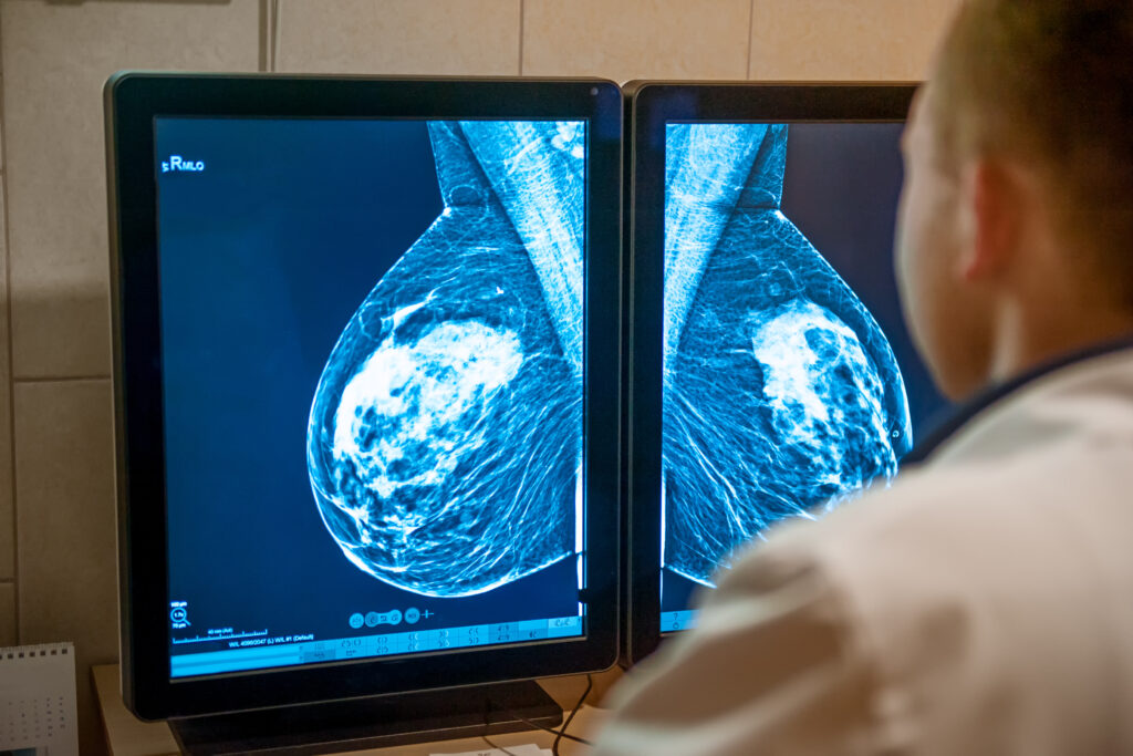 How AI is being used to detect breast cancer